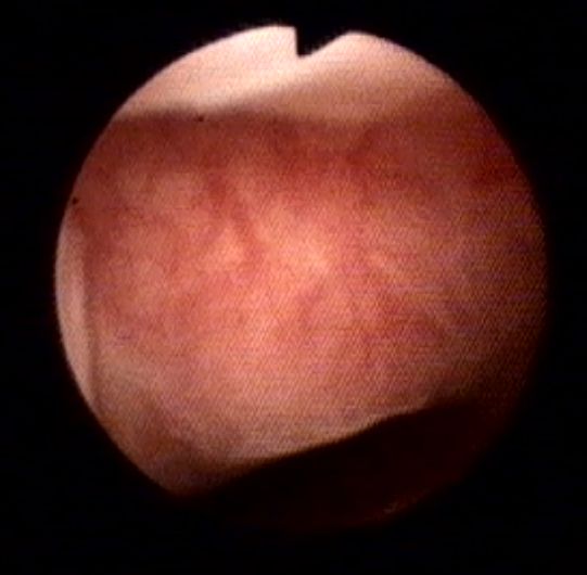 Isthmocele 2