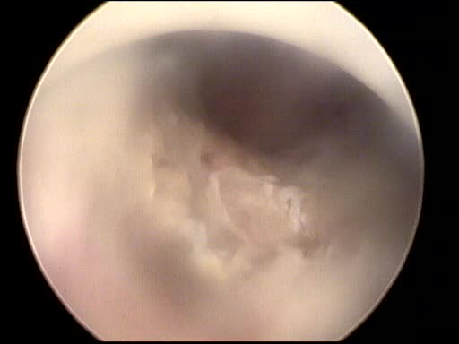 metaplasie osteoide 1 b